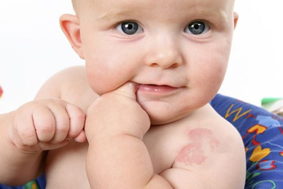 Tipos de marcas de nacimiento en bebés