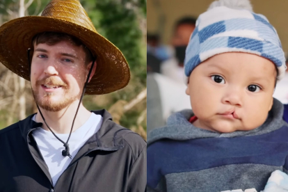 MrBeast regaló 100 cirugías a niños con labio leporino en México